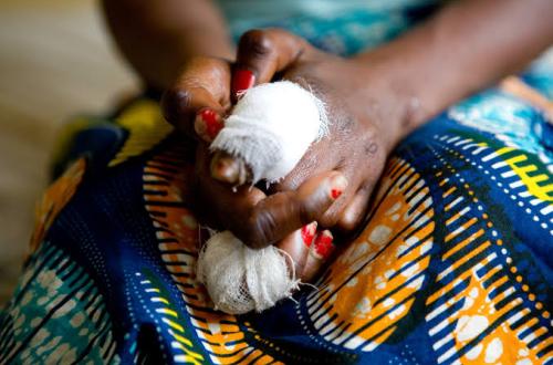 Journée Mondiale de la lèpre : la situation épidémiologique reste instable au Nord-Kivu