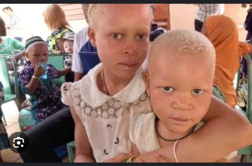 Journée internationale de la sensibilisation à l’albinisme : à Goma, la situation est grave à cause de la guerre