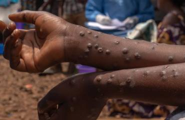 Mpox au Sud-Kivu : l'épidémie s'aggrave, 14 144 cas et 15 décès signalés en 2025